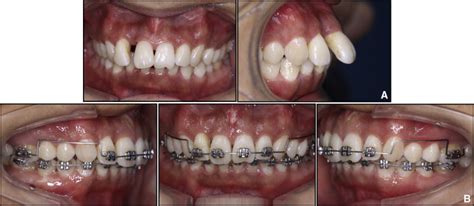 Combined Orthodontic Periodontal Treatment In Periodontal Patients With