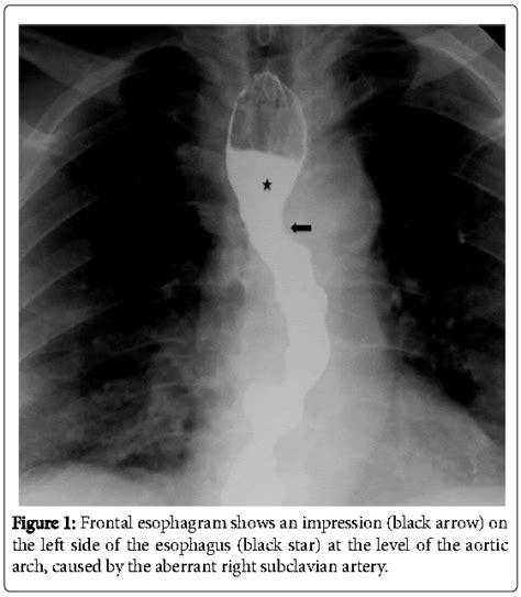 Dysphagia Lusoria An Uncommon Cause Of Dysphagia