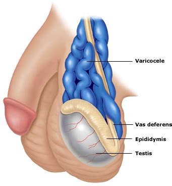 Varicocele Da Defini O Ao Tratamento