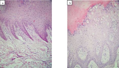 Verruca Vulgaris Histology