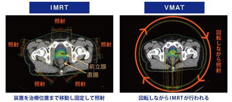 強度変調放射線治療imrt強度変調回転照射vmat 放射線治療科 専門診療科・その他の診療科 診療科・部門 地方独立