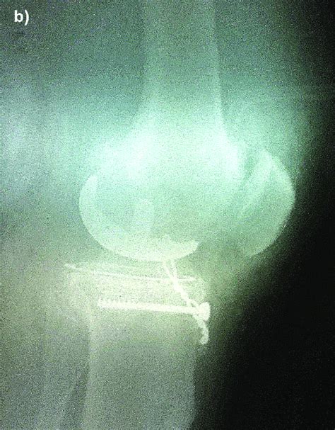 b. Intraoperative fixation of the intercondylar eminence, lateral view. | Download Scientific ...