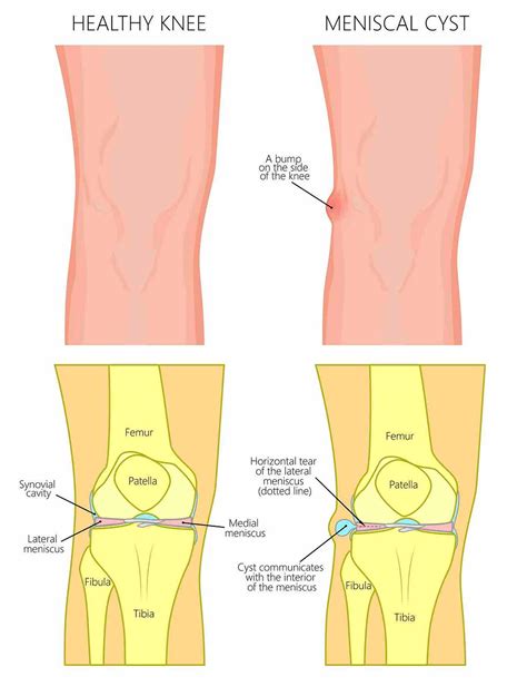 Lump Around The Knee What Is The Cause