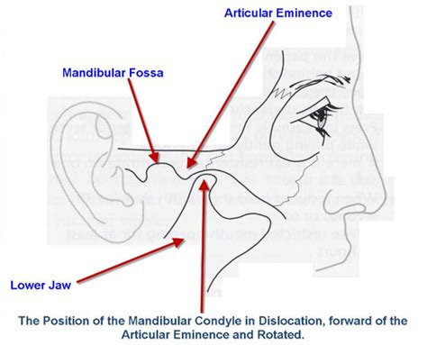 54 Diseases Of The TMJ Dislocation And Subluxation Classification