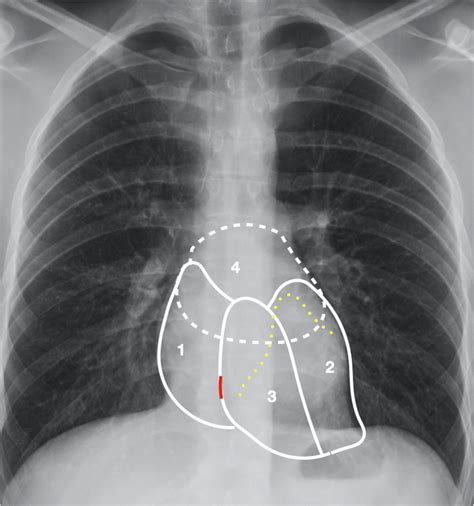 Cardiac Anatomy On Frontal Chest X Ray The Right Atrium Forms The