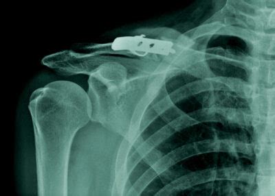 Clavicle Fracture Repair Orthopedic Shoulder Surgeon Vail Aspen