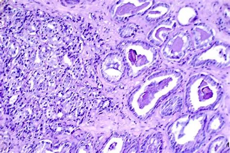 Cancer Cells - Characteristics, Vs normal cells, Types and Microscopy