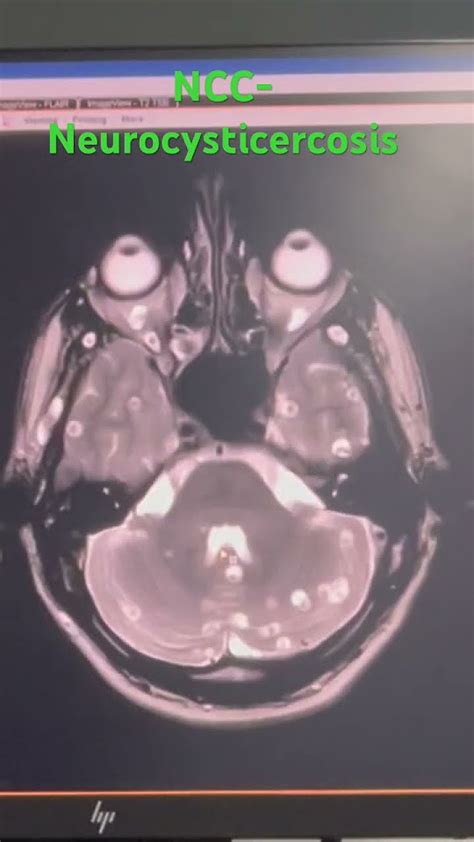 Ncc Neurocysticercosismri Brain Youtube