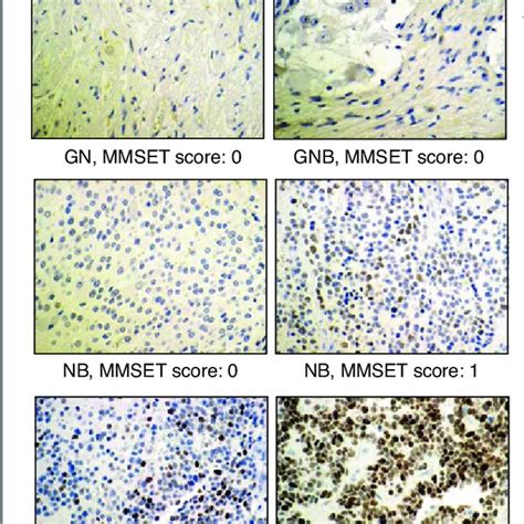 Mmset Expression Pattern In Neuroblastic Tumors A Representative