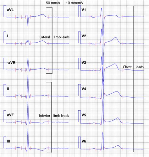 The ECG leads: electrodes, limb leads, chest (precordial) leads, 12 ...