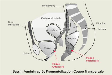 Promontofixation Ou Traitement Des Descentes Dorganes Docteur