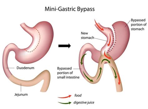 Revision Bariatric Surgery - Sleeve Center