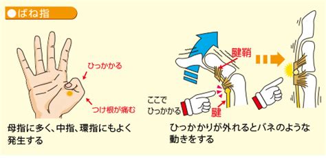 ばね指、腱鞘炎、強直母指 はせべ医院