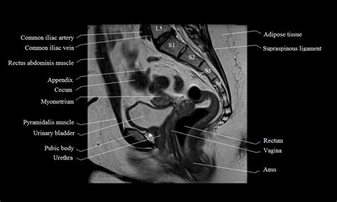 Mri Female Pelvis Anatomy Free Mri Sagittal Cross Sectional Anatomy