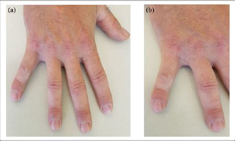 Non Primary Nail Plate Syphilis In An Hiv Infected Patient Semantic