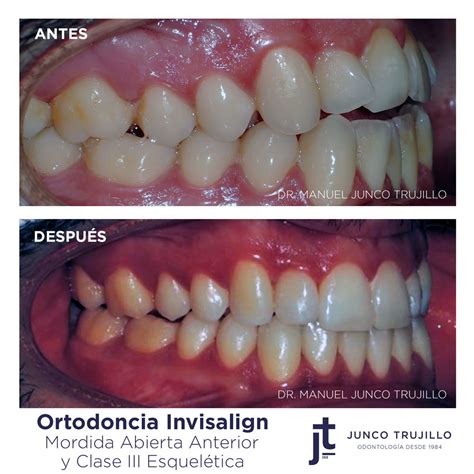 Invisalign Mordida Abierta Anterior Y Clase Iii Esquel Tica Cl Nica