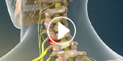 Cervical Facet Radiofrequency Neurotomy Tomoya Sakai MD Spine