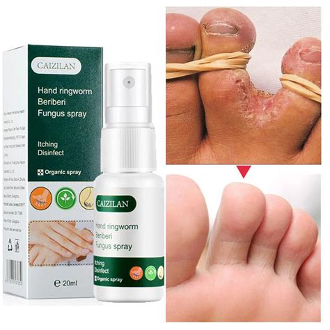 Anti Fungal Spray Foot Fungus Cream Relieve Beriberi Toe Treatment Gel