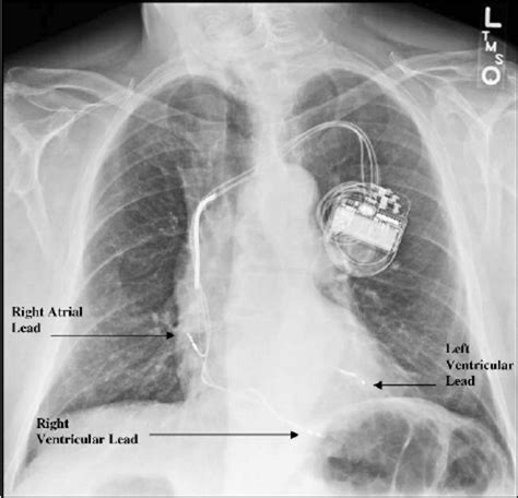 Pacemaker Chest X Ray