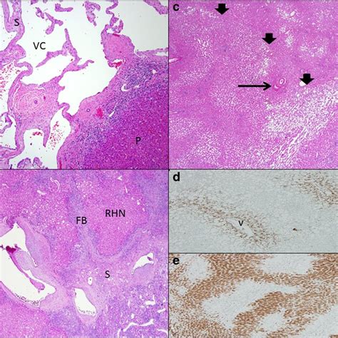 Nodular Regenerative Hyperplasia In A Year Old Male With Year