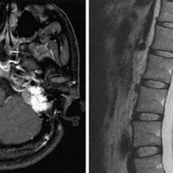 Magnetic Resonance Images Obtained In The Patient In Case