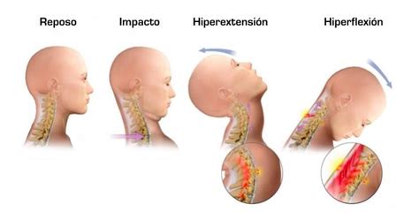 Fisioterapia Para El S Ndrome Del Latigazo Cervical Avanfi