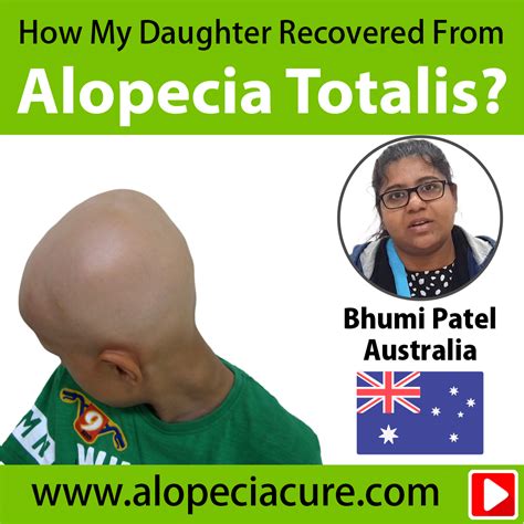 alopecia treatment review/ hair loss treatment review