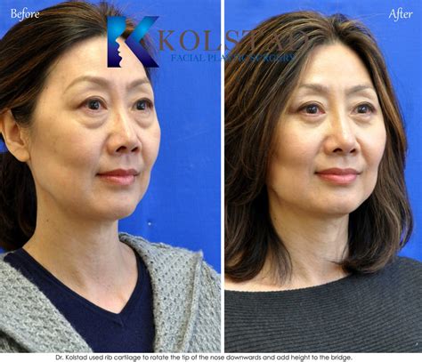 Asian Nose Job Before And After