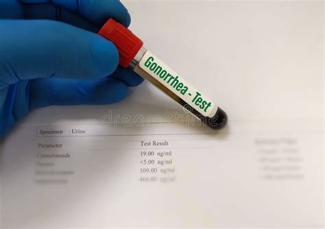 Blood Sample For Vdrl Test Syphilis And Gonorrhea Test Tpha Stock