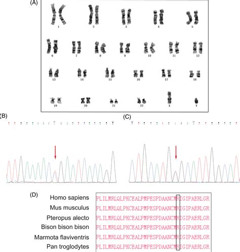 Wholeexome Sequencing Identified Compound Heterozygous Variants In