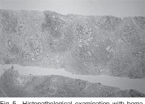 Figure From A Case Of Granulomatous Lobular Mastitis Successfully