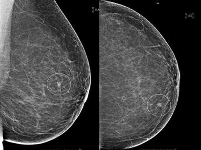 Frontiers Case Report Intraoperative Radiotherapy As The New