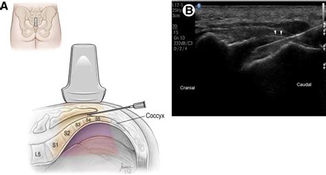 Epidural Caudal Infiltration Under Ultrasound Dr Joe Maalouli