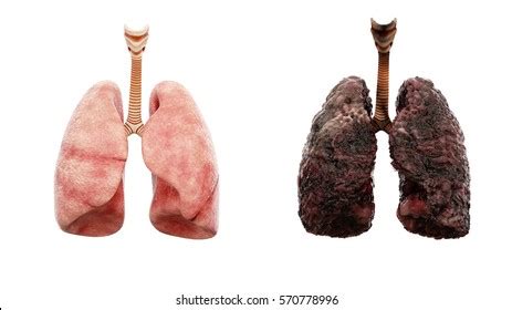 Здоровые Легкие Картинки – Telegraph