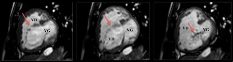 Canal Atrioventriculaire Imagerie Des Malformations Cardiaques