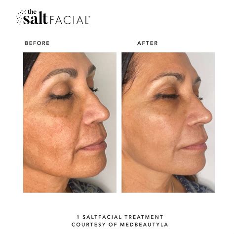 Salt Facial Skin Results Before And After Photos Salt Facial — Nyc Luxury Medical Spa