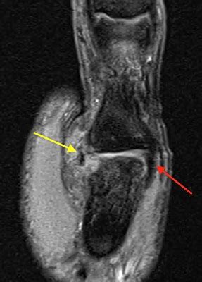 Ulnar Collateral Ligament Wrist Mri