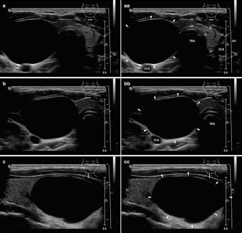 Thyroid Cysts Radiology Key