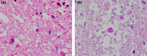 A Japanese Case Of Amoebic Meningoencephalitis Initially Diagnosed By