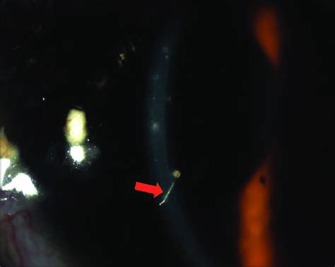 Slitlamp Photograph Of The Left Eye Showing Caterpillar Setae In The