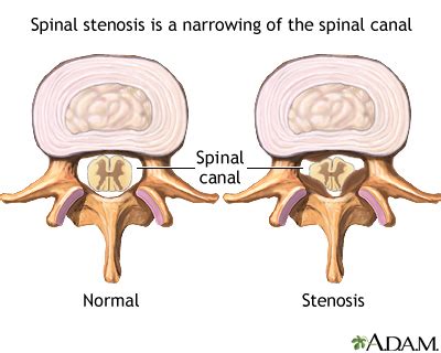 Spinal Stenosis Symptoms, Doctors, Treatments, Advances & More | MediFind