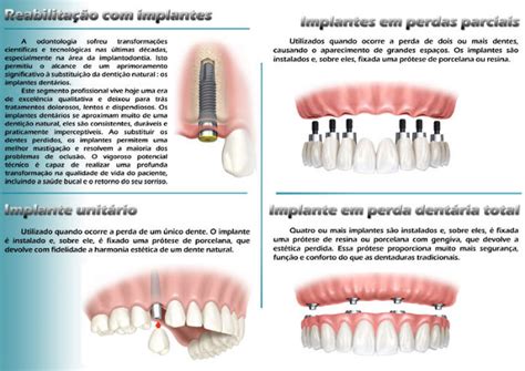 Implantodontia Saiba como funciona o implante dentário