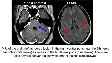 6th Nerve Palsy MRI