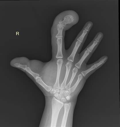 Macrodystrophia Lipomatosa Radiology Case Radiopaedia Org