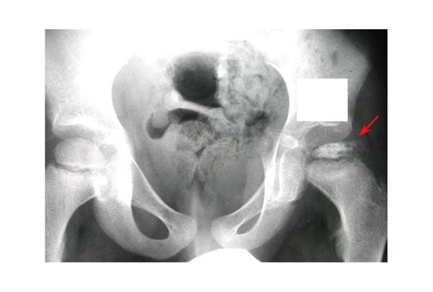 PERTHES DISEASE (LEGG-CALVE-PERTHES DISEASE) - Description