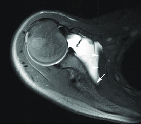 Anterior Capsular Stripping Axial T1 Fat Saturated MR Arthrogram