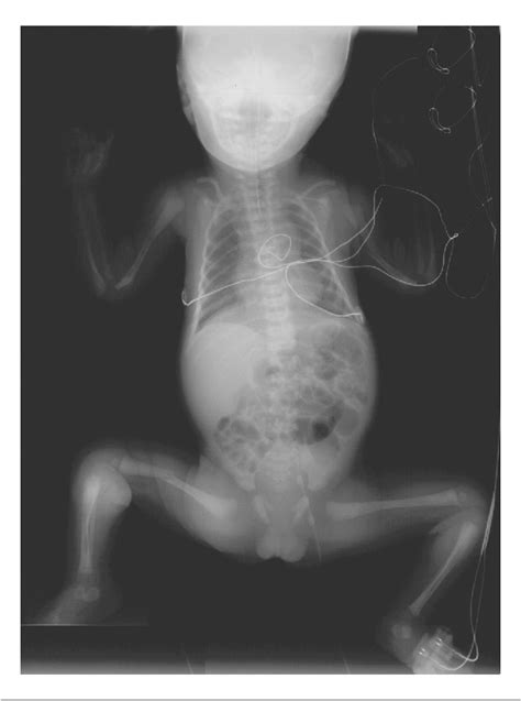 Figure From Neonatal Spinal Muscular Atrophy Type With Bone