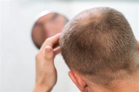 Puede Crecer El Pelo En Zonas Calvas