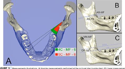 Figure 1 from Mandibular foramen location | Semantic Scholar