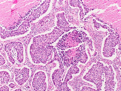 Large Cell Neuroendocrine Carcinoma A Photo On Flickriver